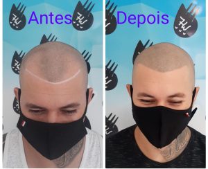 Sobre clínica de micropigmentação capilar em Santo André teria alguma dúvida?