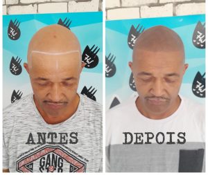 Clínica de Micropigmentação Capilar em Santo André